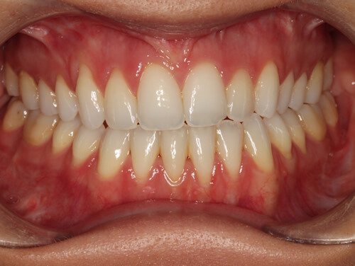Jaw Surgery After Jaw Surgery After