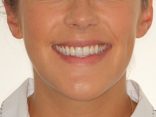 Orthognathic Surgery After Orthognathic Surgery After