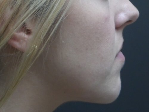 Jaw Surgery Before Side View Jaw Surgery Before Side View