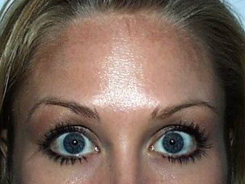 Botox® Treatment After Botox® Treatment After