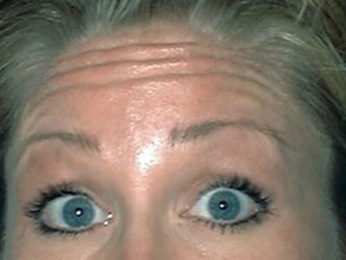 Botox® Treatment Before Botox® Treatment Before
