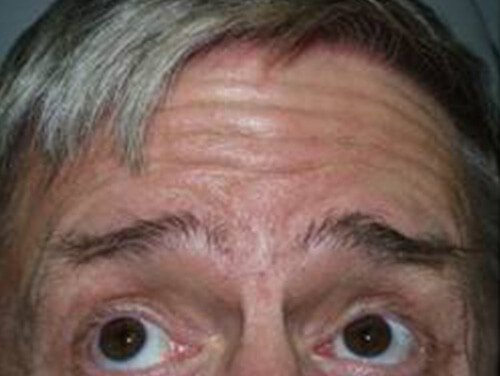 Botox® Procedure Before Botox® Procedure Before