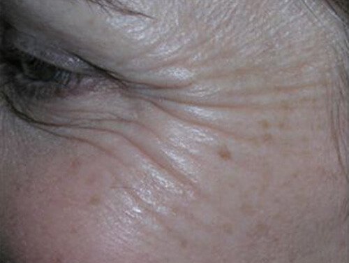 Botox® Cosmetic Injections Before Botox® Cosmetic Injections Before