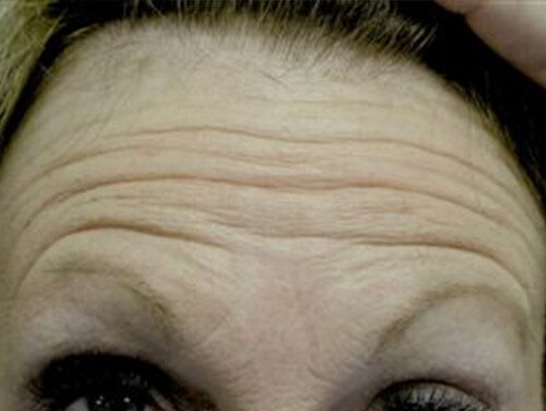 Botox® Injections Before Botox® Injections Before