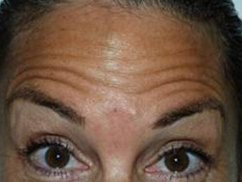 Botox® Cosmetic Treatment Before Botox® Cosmetic Treatment Before